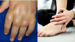 गठिया के शुरुआती लक्षणों को न करें अनदेखा 