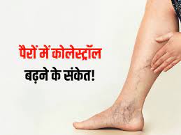 कोलेस्ट्रॉल के न करें अनदेखा वरना हो सकते हैं बड़े बीमारी का शिकार 