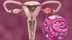 जानें- Ovarian Cyst होने पर शरीर में नजर आते हैं ये लक्षण