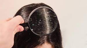 डैंड्रफ की समस्या से हो चुके हैं परेशान,तो आजमाएं ये घरेलू नुस्खा 