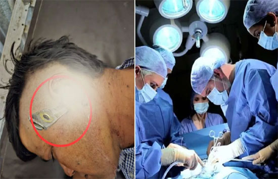 युवक के सिर में 7 इंच अंदर तक धंसा था चाकू, 45 KM का सफर तय कर पहुंचा अस्पताल 