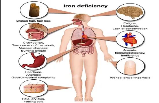  जानें -आयरन की कमी के ऐसे लक्षण कहीं आपको भी तो नहीं 