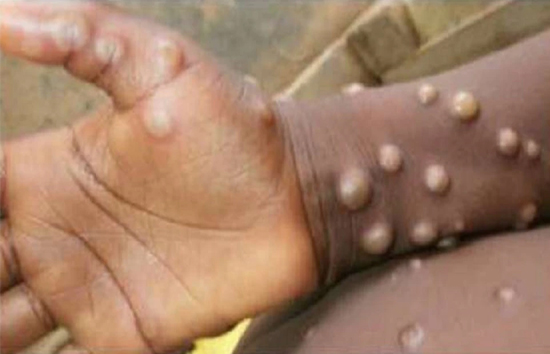 दुनियाभर में तेजी से फैल रहा मंकीपॉक्स संक्रमण, अब तक 20 देशों तक पहुंचा